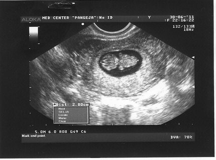 Εμβρυϊκή ανάπτυξη και αίσθηση μιας γυναίκας κατά την εβδομάδα της εγκυμοσύνης