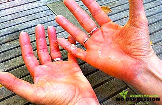 How to treat psoriasis on the hands at an early stage