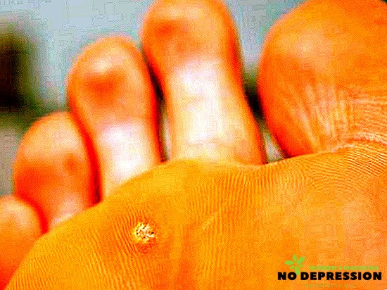 Wie behandelt man Sporen am Fuß?