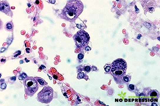 Apa itu sitomegalovirus dan bagaimana cara mengobati penyakit?