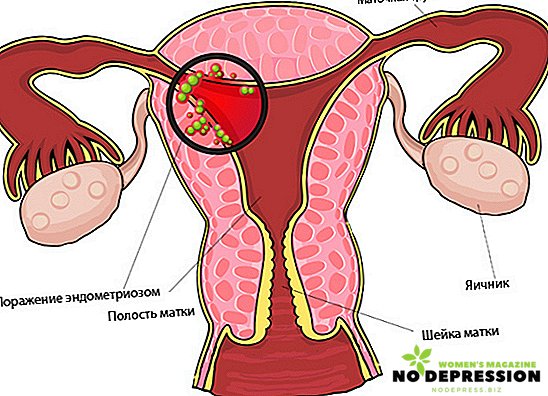 Was ist eine Endometriose der Gebärmutter und wie wird sie behandelt?