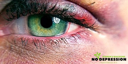 Wie kann man den Bluterguss unter dem Auge schnell und einfach von dem Schlag loswerden?