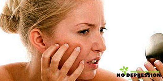 Como se livrar rapidamente da acne em casa