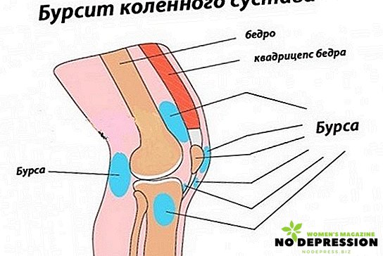 How to treat knee bursitis at home