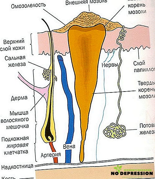 How to treat natoptysh on the sole with the rod