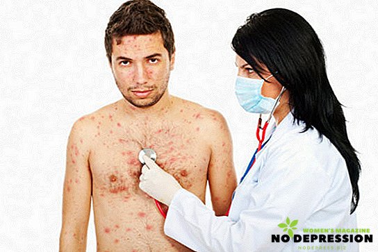 Comment traiter la varicelle chez les adultes à la maison