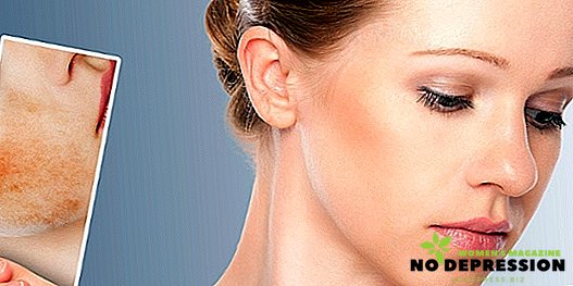 Ako môžem odstrániť sčervenanie na tvári po stlačení akné