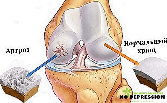 Kako mogu liječiti osteoartritis zgloba koljena