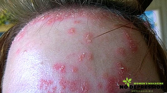 ¿Cómo se ve la psoriasis en la cara y cómo tratarla de manera efectiva?