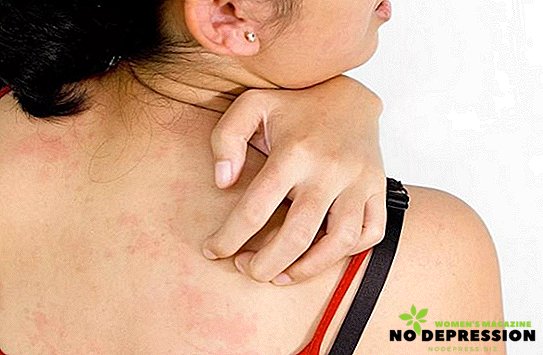 How to cure acne on the back of women