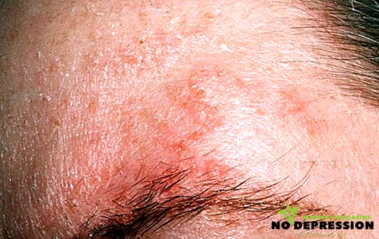 Come curare la dermatite seborroica sulla testa e sul viso
