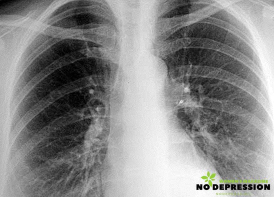 Vápnik v pľúcach: príčiny, príznaky a liečba