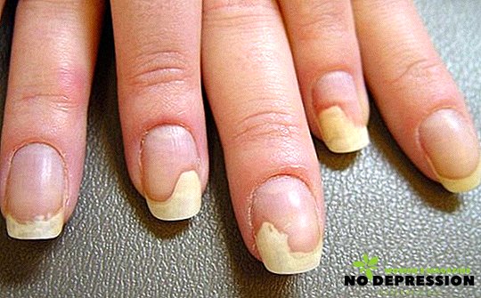 Liječenje gljiva noktiju na rukama različitih metoda i narodnih lijekova