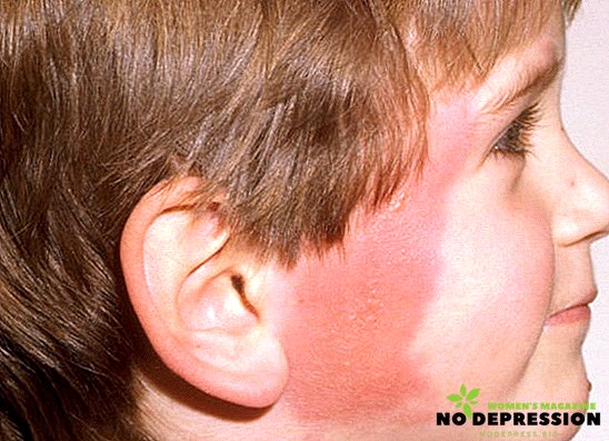 Tratamiento de las erisipelas de la piel de la cara y extremidades.