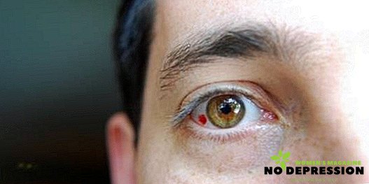 Vaso de ruptura en el ojo: causas, control de las consecuencias y tratamiento posterior.