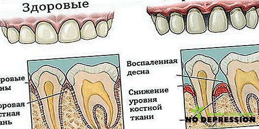 Parodontalna bolezen: kako rešiti zobe, katera zdravila resnično pomagajo