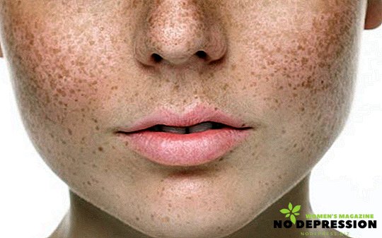 顔面色素沈着：原因と治療方法