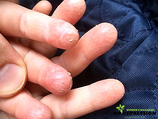 Zakaj koža okoli prstov: razlogi