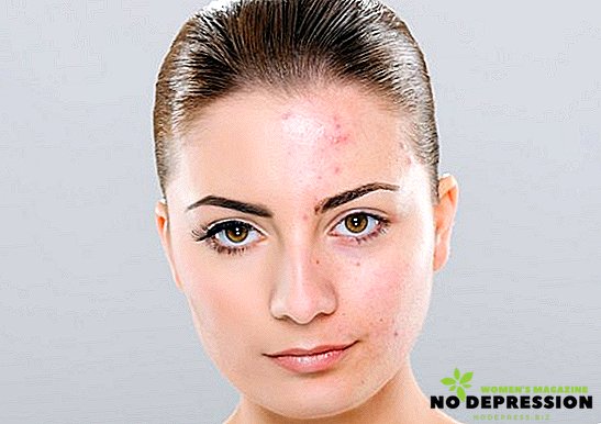 Perché l'acne appare sul viso e come rimuoverlo