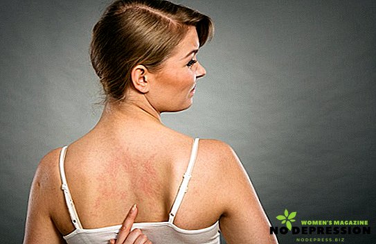 Waarom verschijnen er acne op de rug en schouders en hoe kunnen ze worden kwijtgeraakt