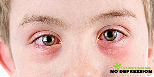 Sarkanas acis: fotogrāfijas, iespējamie cēloņi un ārstēšanas metodes