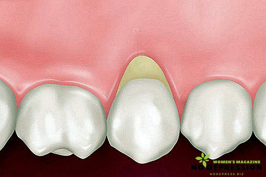 Causas e tratamento de defeito em forma de cunha de dentes