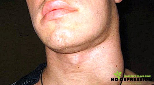 Causes and methods of treatment of inflammation of the lymph nodes in the neck