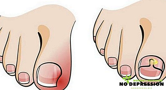 Orsaker och metoder för behandling av ingrown tånagel