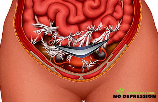 Causas, sintomas e tratamento da doença adesiva da cavidade abdominal