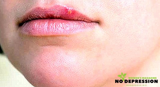 Hladna na ustnicah: učinkovite metode boja