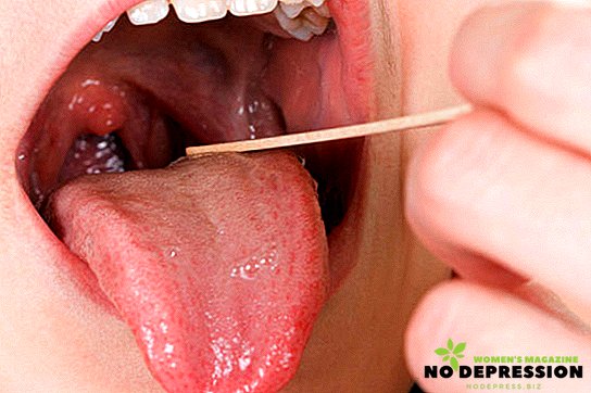 Symptoms and treatment of follicular tonsillitis in adults