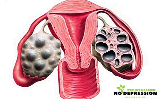 Symptomer og behandling av polycystisk ovarie