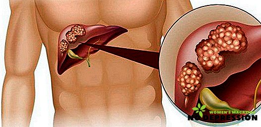 Симптоми и лечение на полипоза на жлъчния мехур