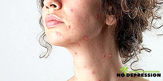 Síntomas y características del tratamiento de la varicela en un adulto.