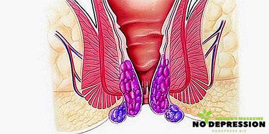 Symptomer og årsaker til indre hemorroider