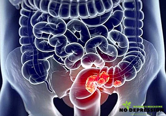 Sintomi di tumori intestinali
