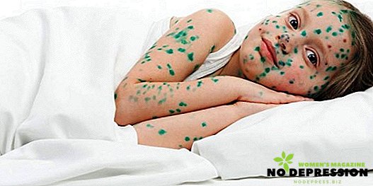 How long is the incubation period of chickenpox in children, how to treat the disease