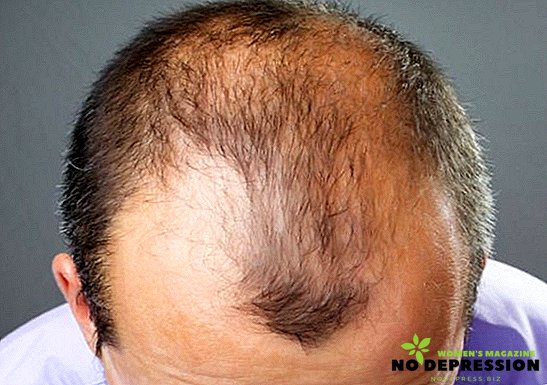 TOP-medel för baldness hos män